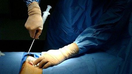 ¿Cómo se lleva a cabo un trasplante de médula ósea?