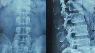 Can Medical Malpractice Cause a Spinal Cord Injury?