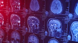 Recognizing Meningioma Symptoms: A Guide for Long-Term Depo-Provera Users