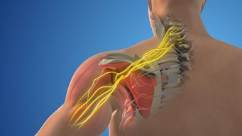 Brachial Plexus Injuries FAQs