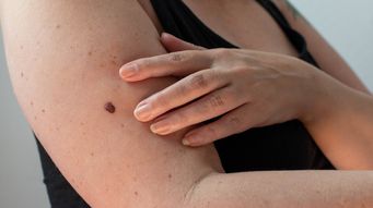 Melanoma skin cancer cases at an all-time high in UK