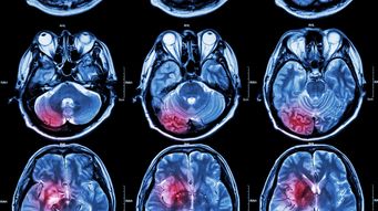 Meningiomas and Depo-Provera: Where to Get Help