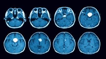 Meningioma and Birth Control Lawsuits: The Case Against Depo-Provera