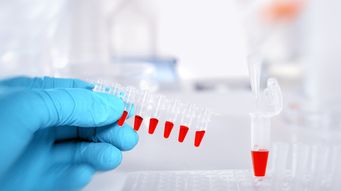 Getting Closer to a Definitive Biomarker for Parkinson's Disease