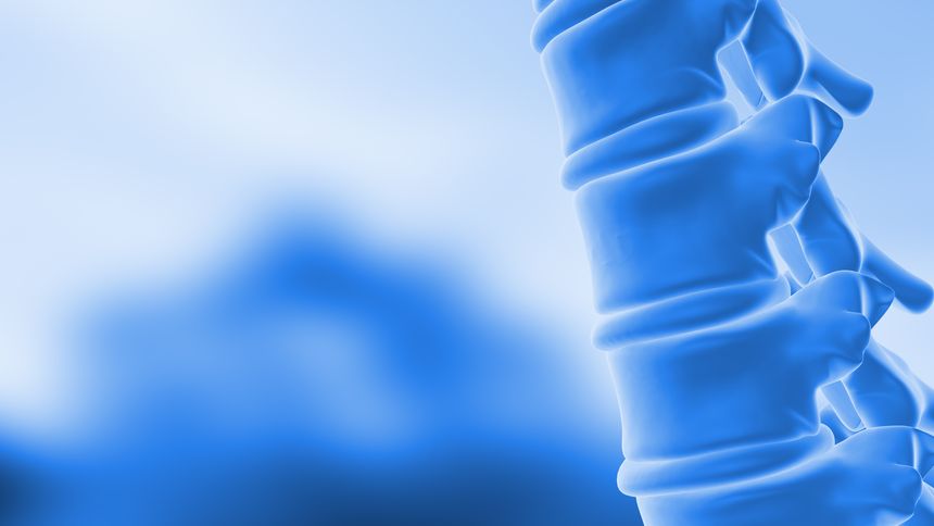 A spinal wedge, also known as a wedge fracture or compression fracture, is a type of fracture that occurs when the front of a vertebra collapses. This leaves the back of the vertebra intact, resulting in a wedge shape.