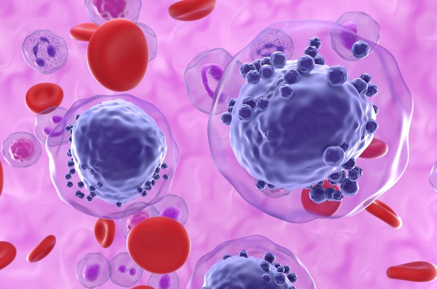 Acute myeloid leukemia AML is a type of blood cancer. It starts in your bone marrow, the soft inner parts of bones. AML usually begins in cells that turn into white blood cells, but it can start in other blood-forming cells, as well.