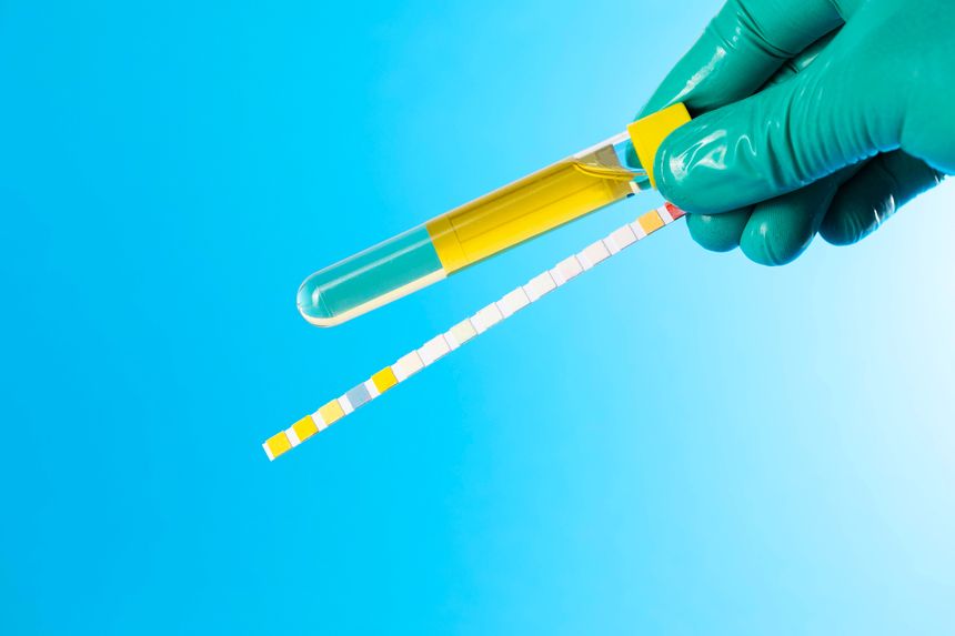 A lab technician's hand, wearing a medical glove, holds a urine culture tube and a urine pH test strip against a blue background. Concept of urine testing and analysis for infections. Copy space for text