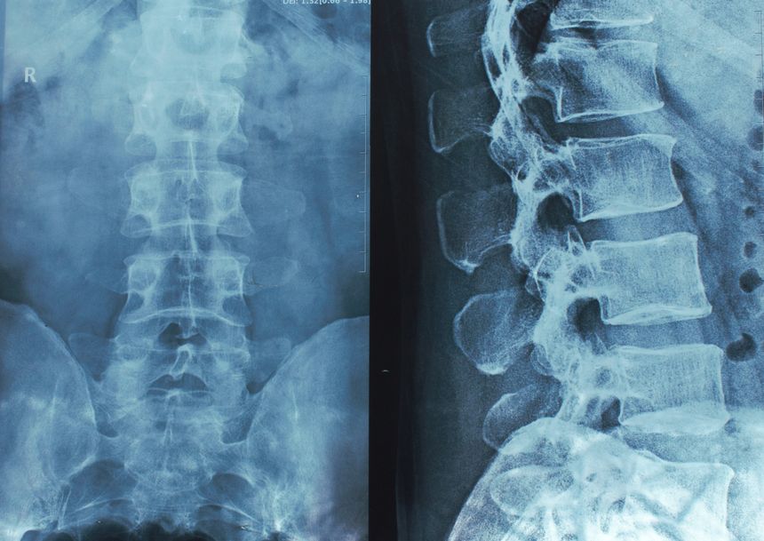 x-ray of the spine lumbar sacral