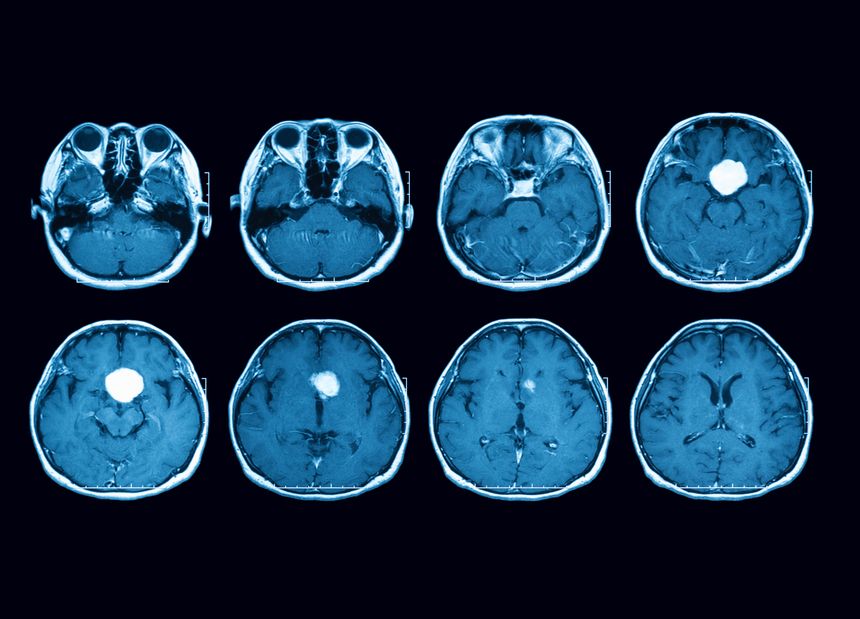 Magnetic resonance imaging (MRI) scan of the brain with gadolinium (GD) contrast medium injections , transverse view, case of pituitary mass